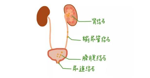 尿道结石.jpg