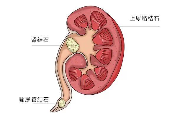 肾结石.jpg